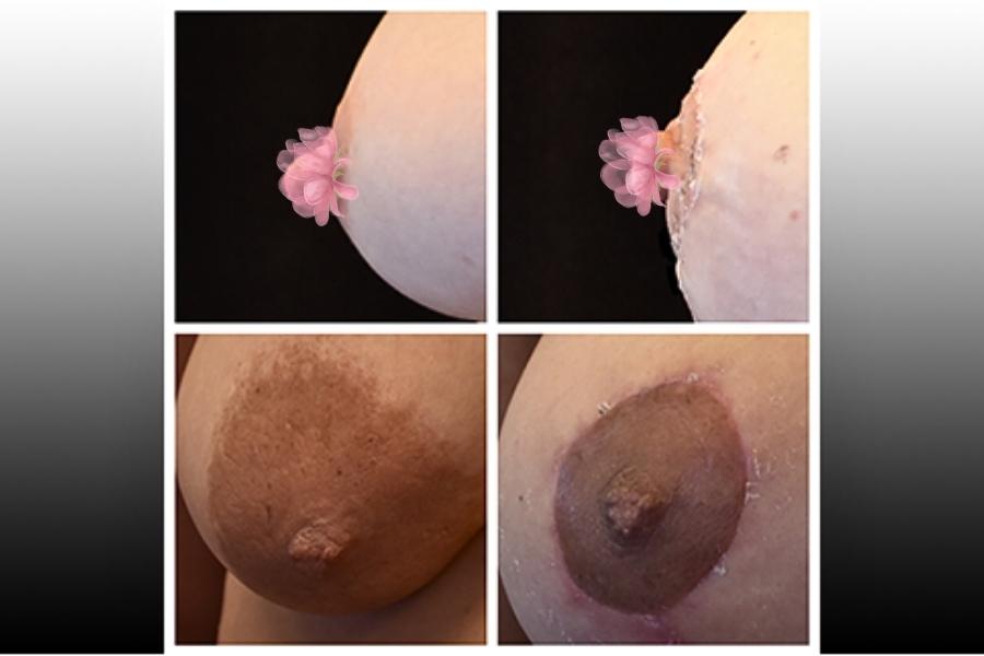 Không nên thực hiện thu gọn quầng nhũ hoa giá rẻ