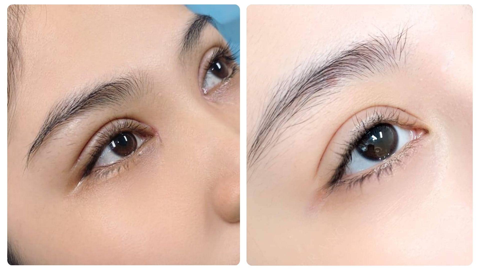 Kiêng khem sau khi cắt mí sẽ giúp vết cắt mau hồi phục hơn