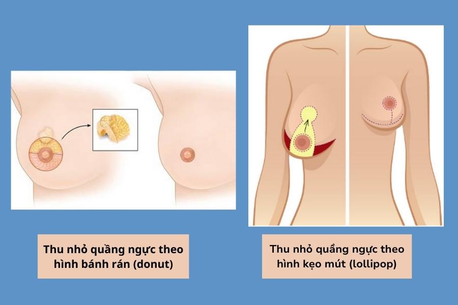 Phương pháp thu nhỏ quầng nhũ hoa hình bánh rán và hình kẹo mút